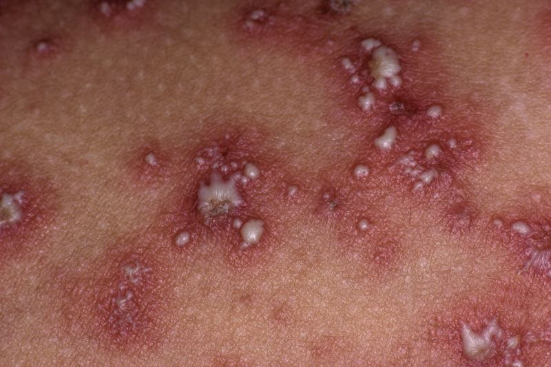 psoriasis pustulosa leve